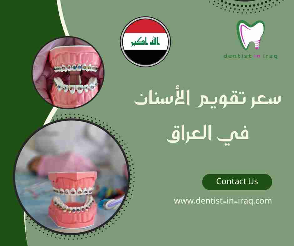 سعر تقويم الأسنان في العراق