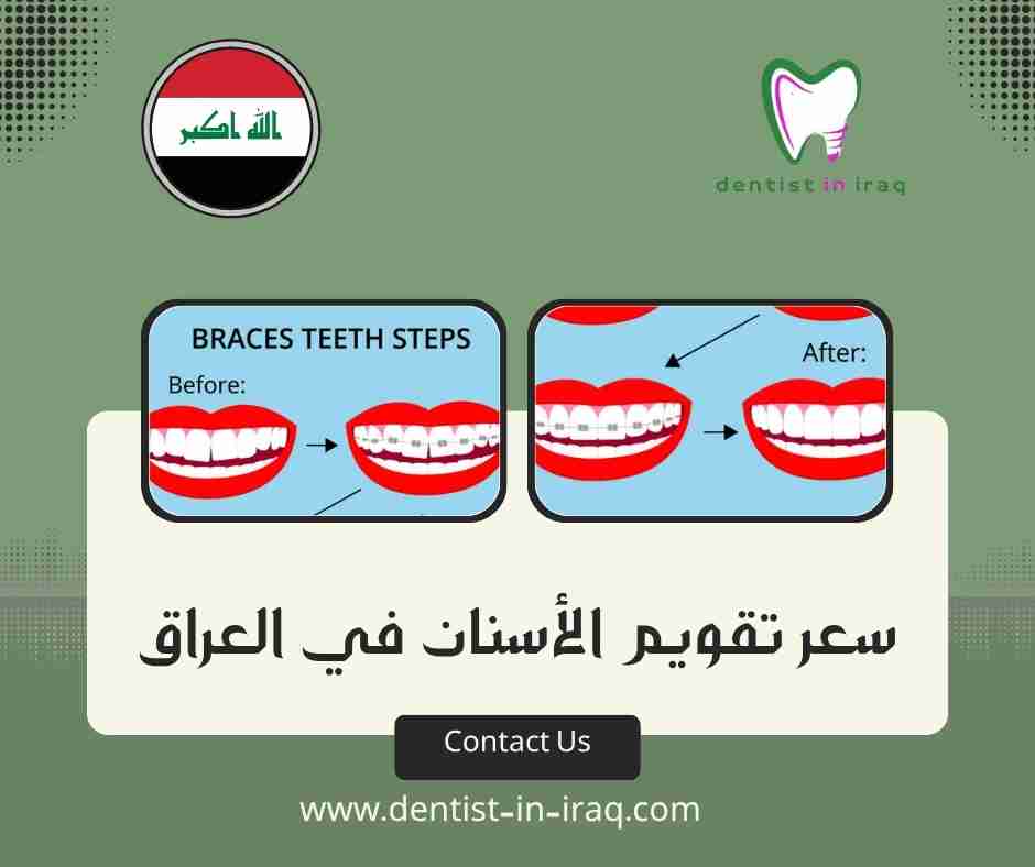 سعر تقويم الأسنان في العراق