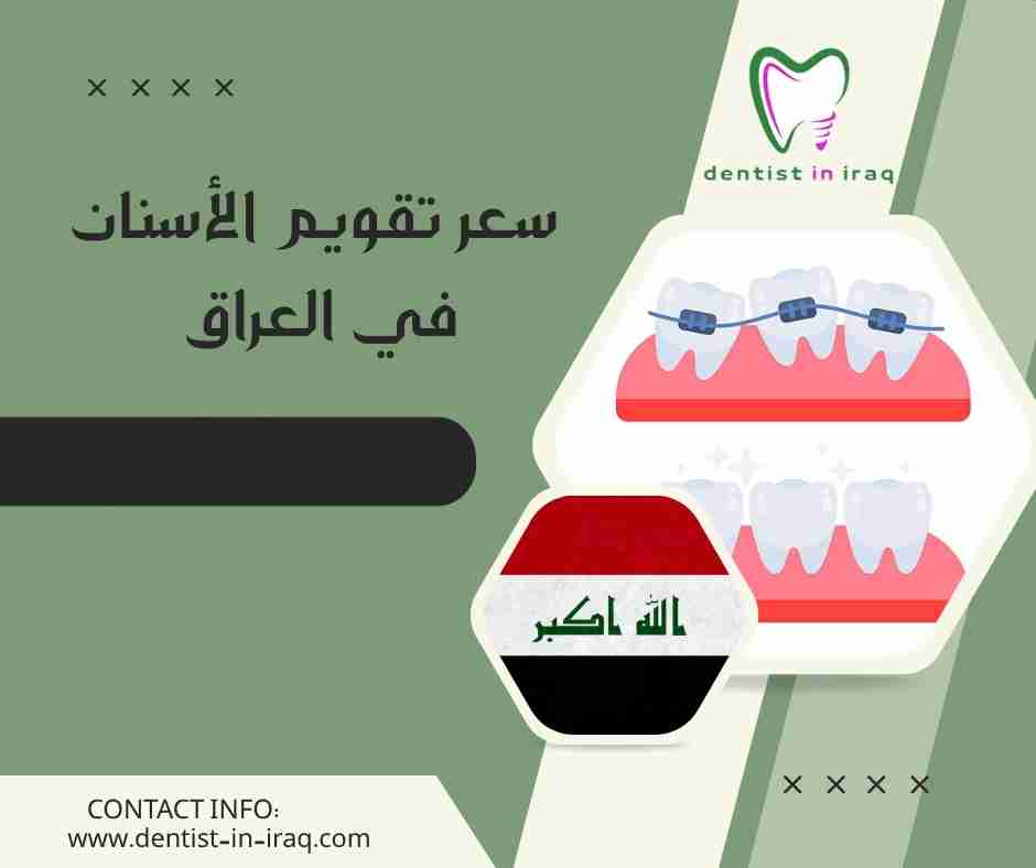 سعر تقويم الأسنان في العراق