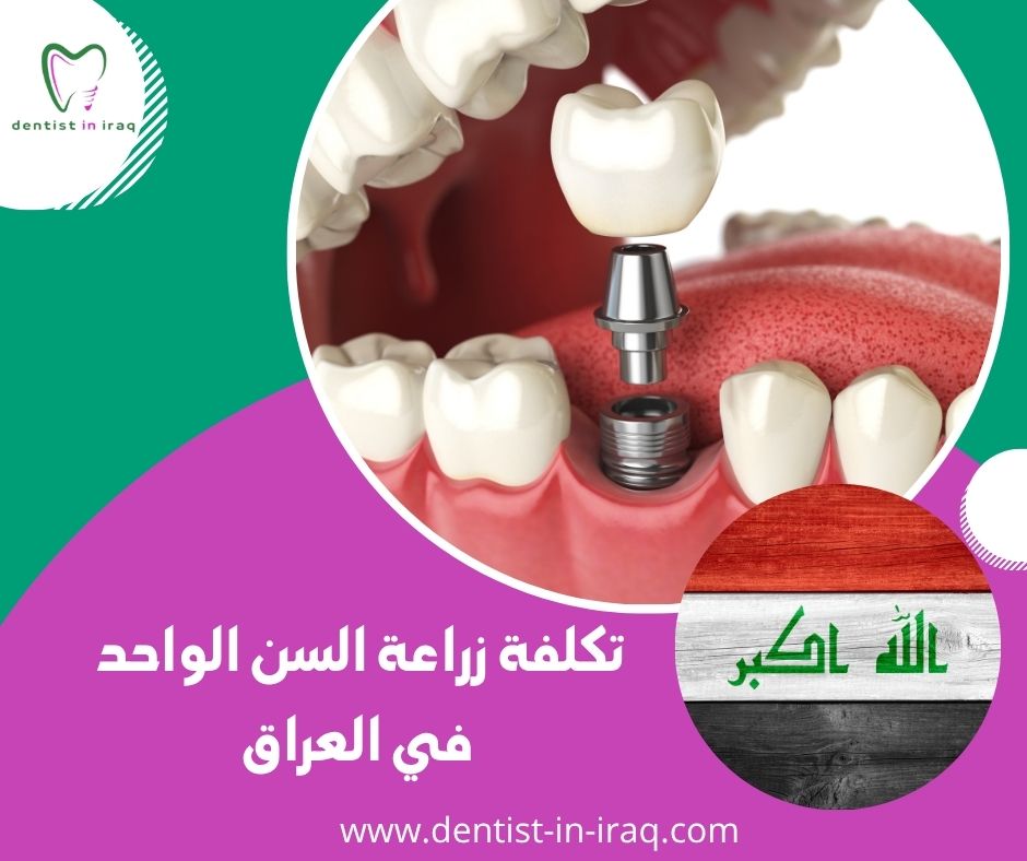 تكلفة زراعة السن الواحد في العراق