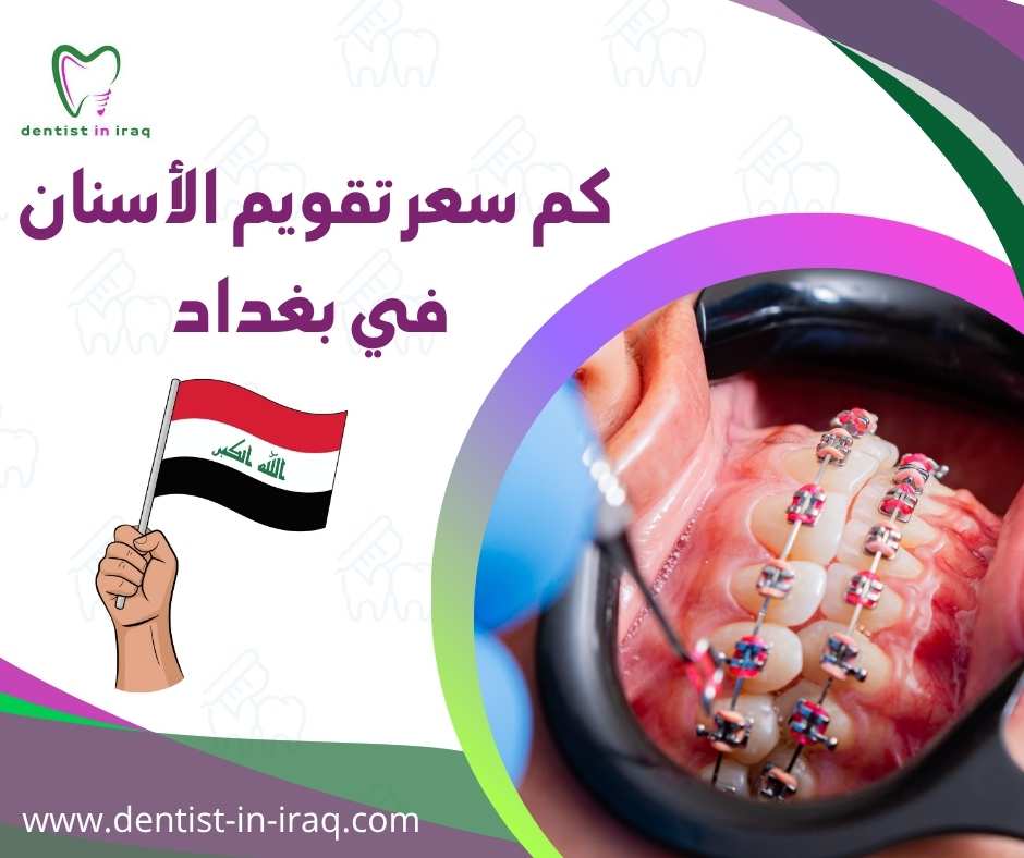 كم سعر تقويم الأسنان في بغداد