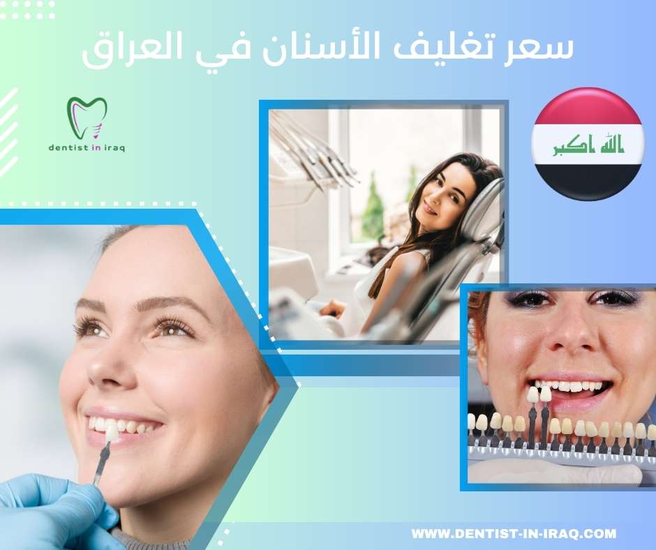 سعر تغليف الأسنان في العراق