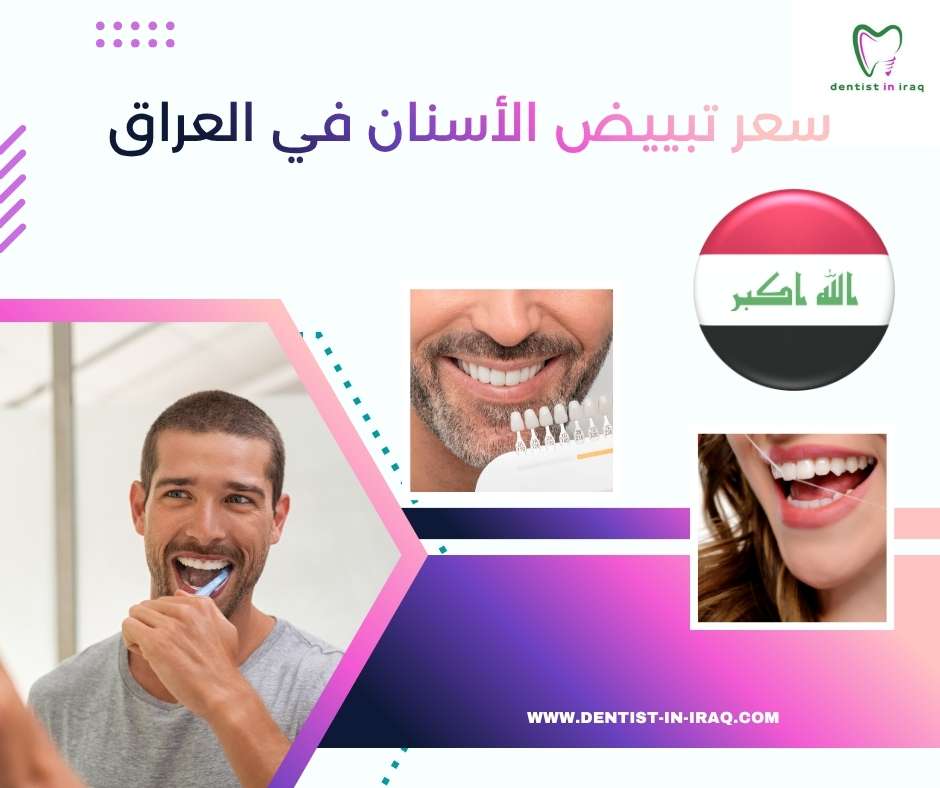 سعر تبييض الأسنان في العراق