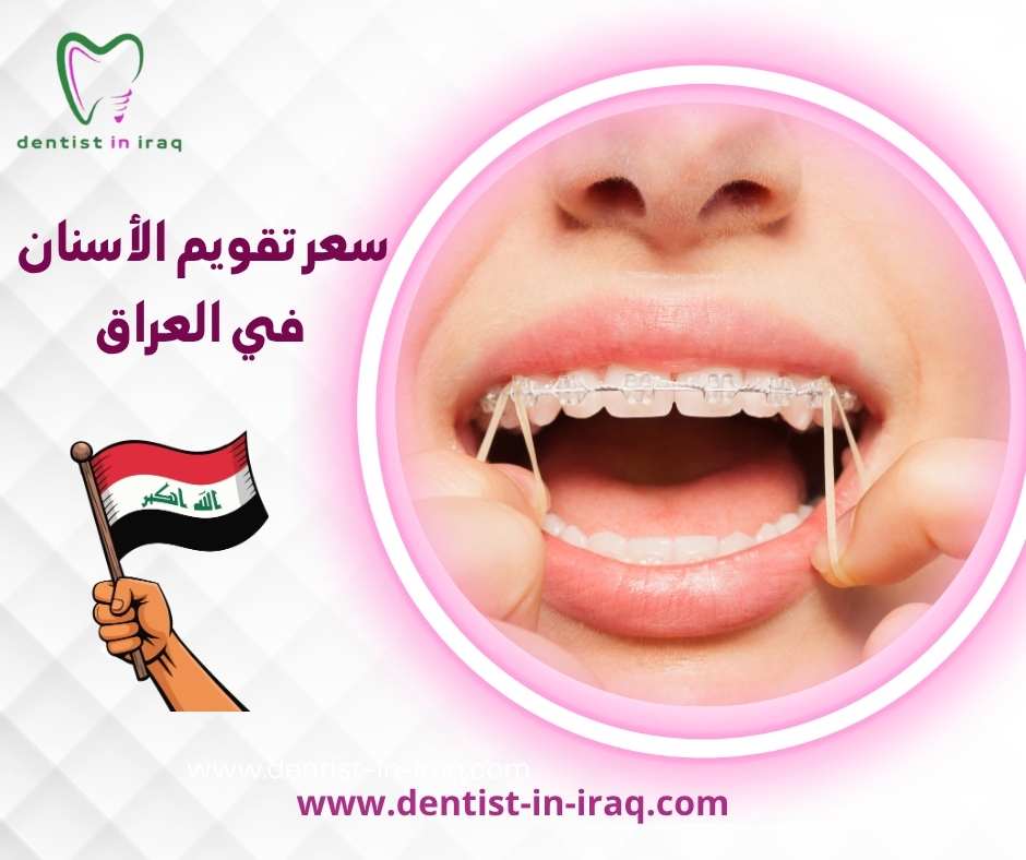 سعر تقويم الأسنان في العراق