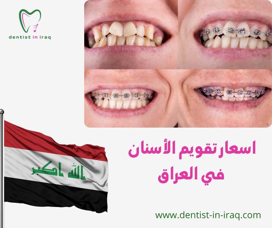 اسعار تقويم الأسنان في العراق