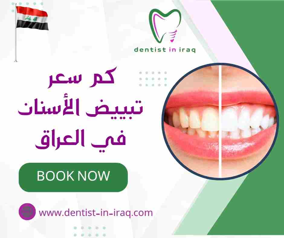كم سعر تبييض الأسنان في العراق