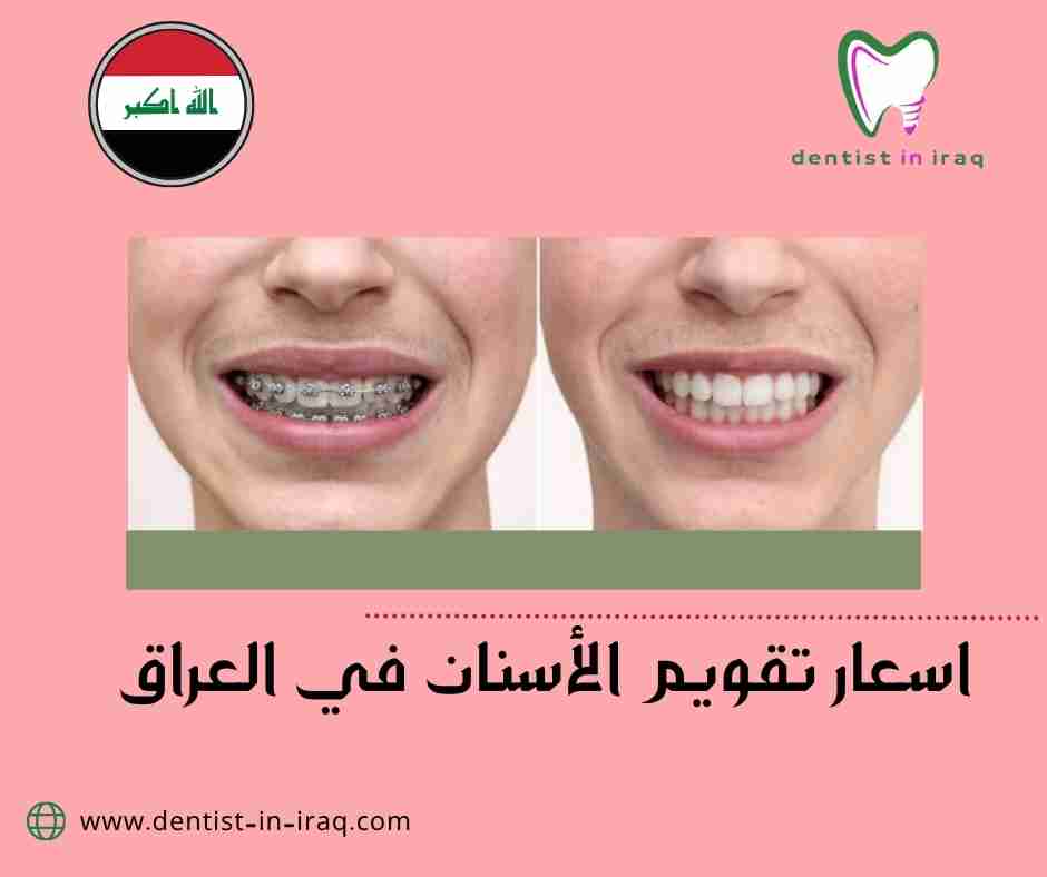 اسعار تقويم الأسنان في العراق