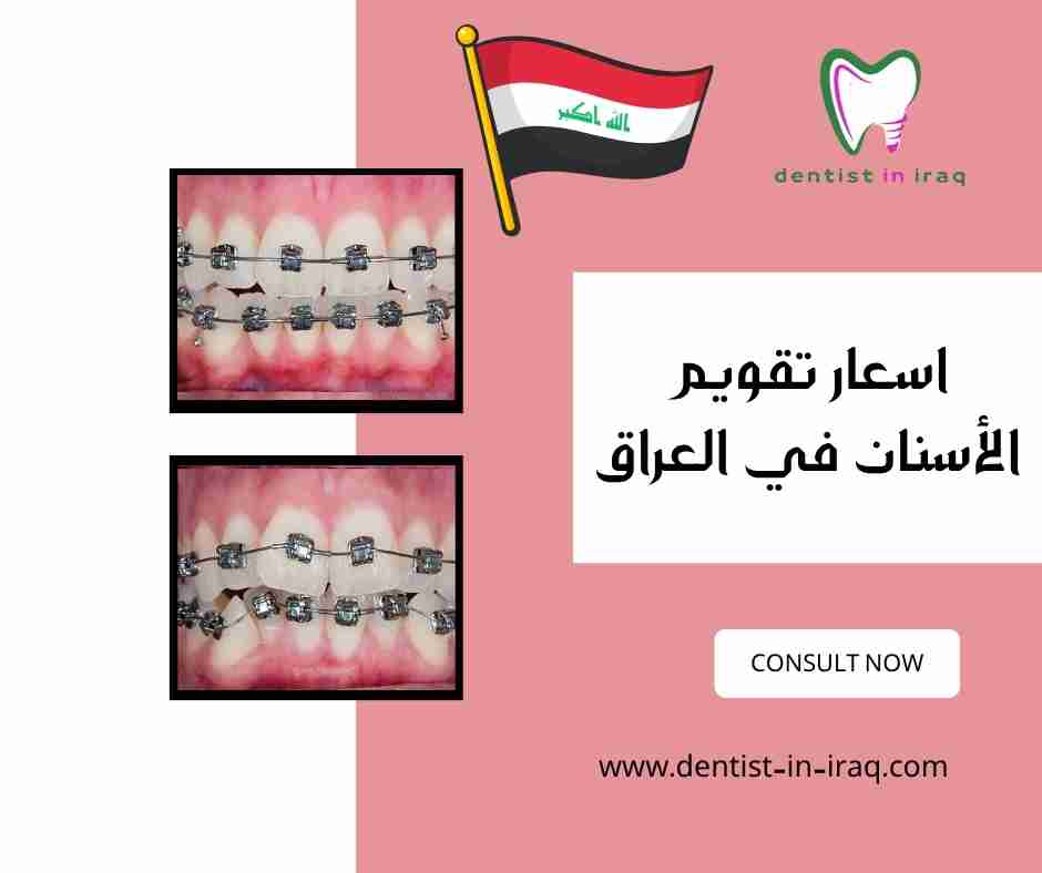 اسعار تقويم الأسنان في العراق