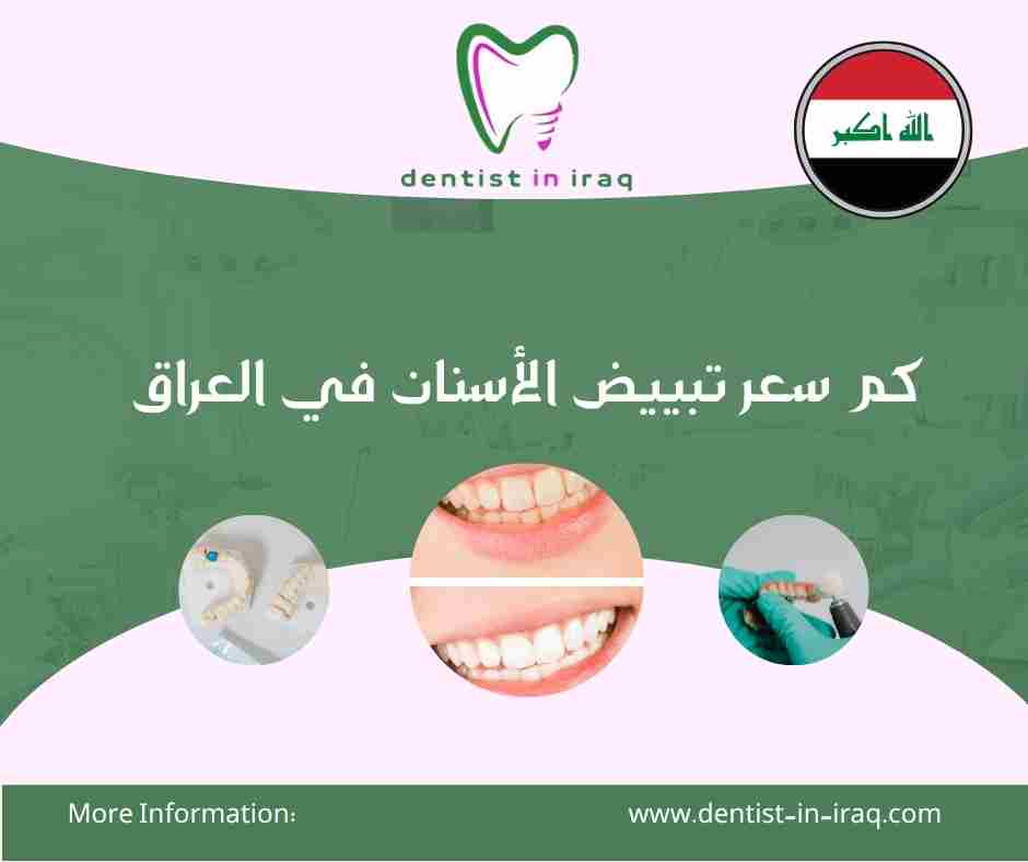 كم سعر تبييض الأسنان في العراق