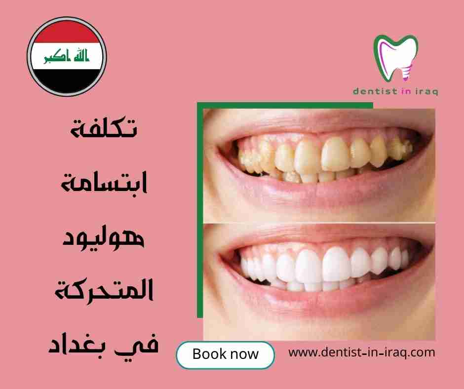 تكلفة ابتسامة هوليود المتحركة في بغداد