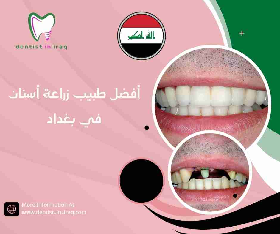 أفضل طبيب زراعة أسنان في بغداد