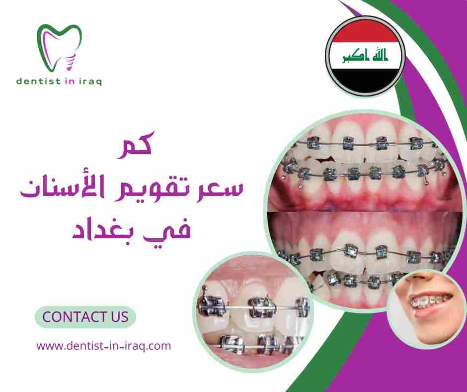 كم سعر تقويم الأسنان في بغداد