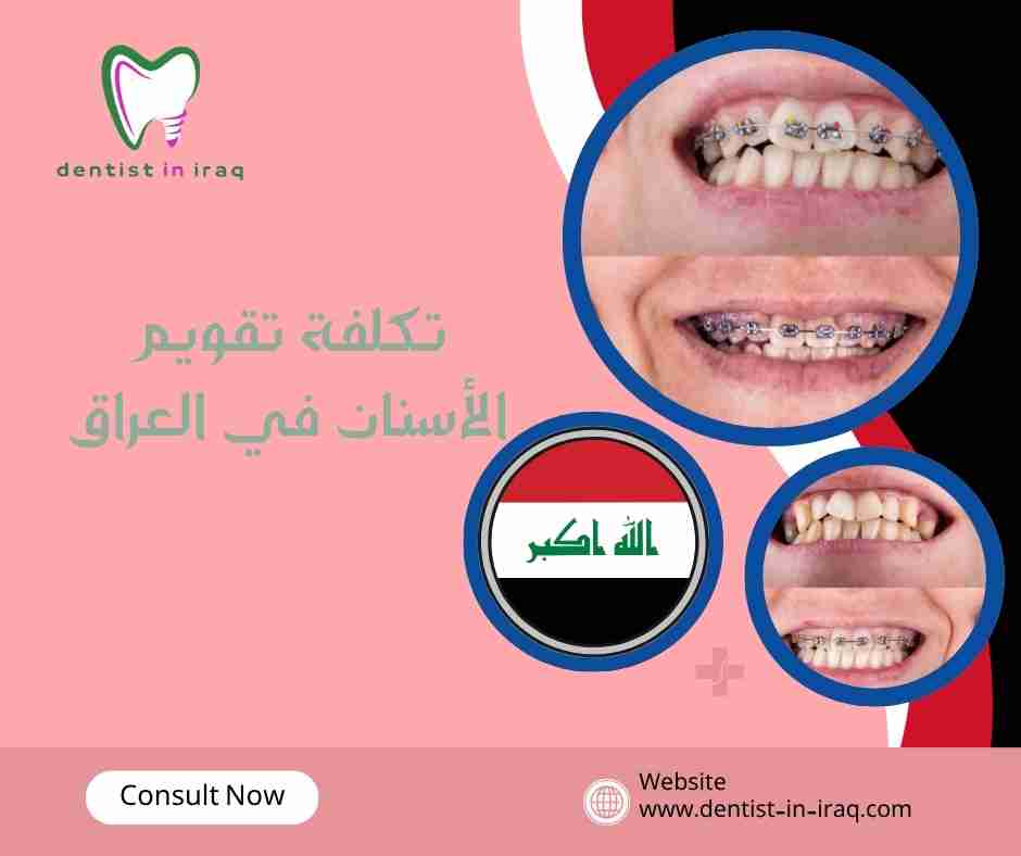 تكلفة تقويم الأسنان في العراق