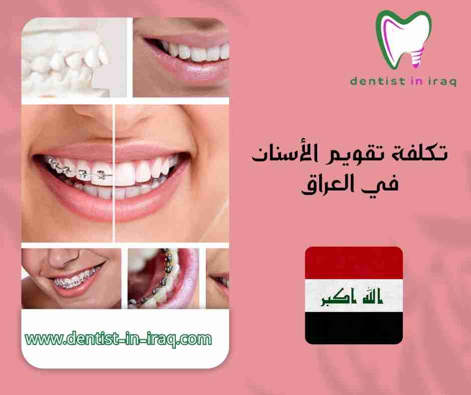 تكلفة تقويم الأسنان في العراق
