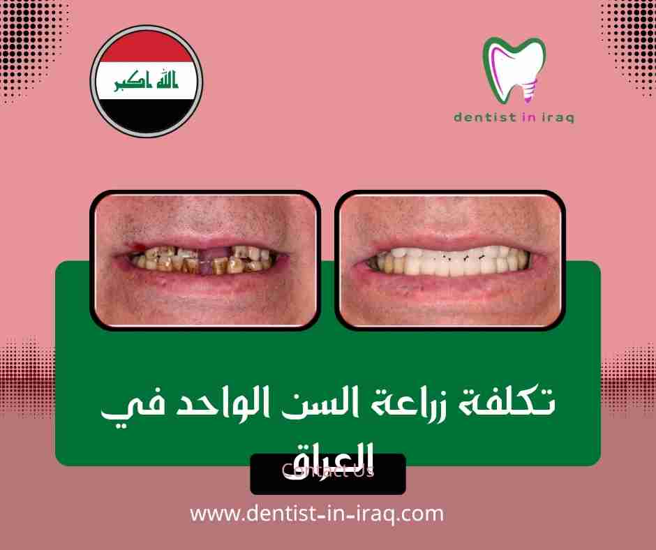 تكلفة زراعة السن الواحد في العراق