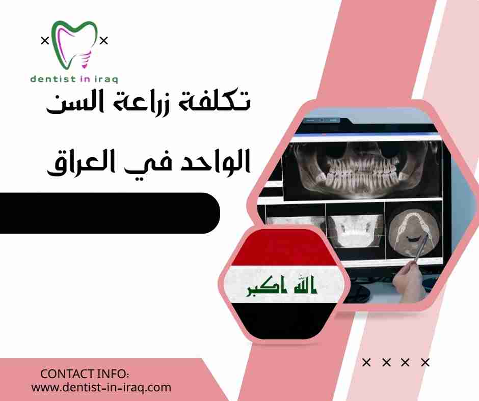 تكلفة زراعة السن الواحد في العراق