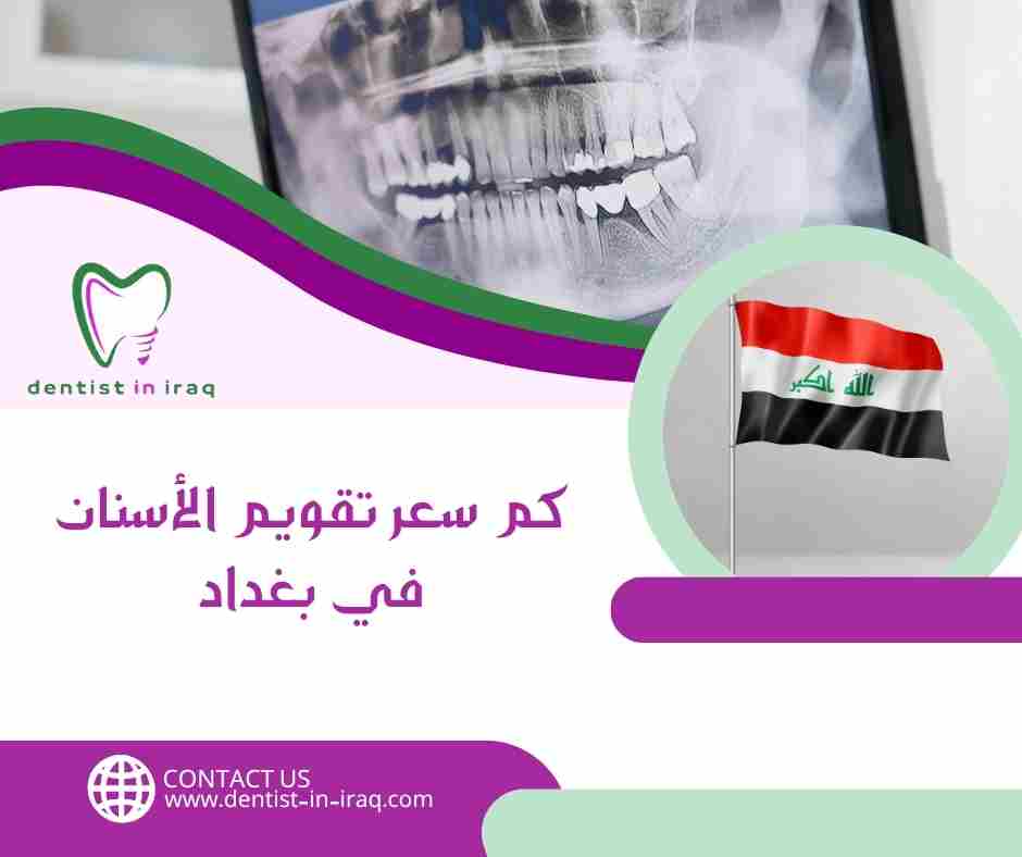 كم سعر تقويم الأسنان في بغداد