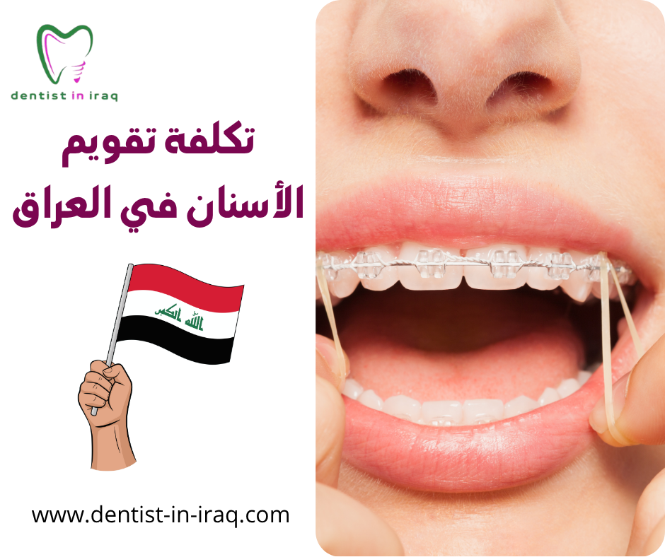 تكلفة تقويم الأسنان في العراق